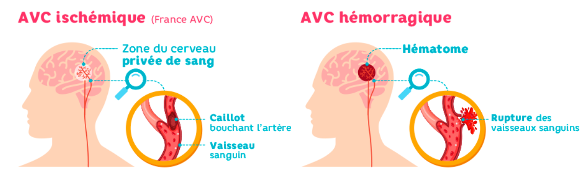 AVC ischmique et AVC hémorragique